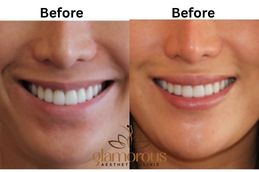 Before and after Dimple creation result in Riyadh ,Saudi Arabia