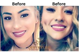 Before and after Dimple creation result in Riyadh ,Saudia Arabia