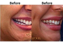 Before and after Dimple creation result in Riyadh Saudia