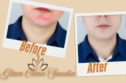 Laser treatment befotre and After in Riyadh Saudia Arabia