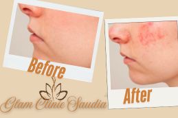 Laser treatment befotre and After in Riyadh KSA