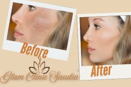 Laser treatment befotre and After in Riyadh Saudia