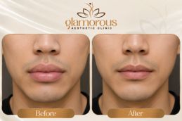 Lip Reduction Before and After