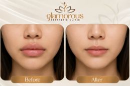 Lip reduction before and after in jeddah