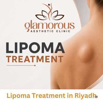 Lipoma Treatment in Riyadh
