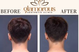 Trichologists Before and After Result KSA