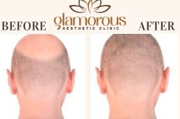 Trichologists Before and After Result Riyadh KSA