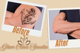 before and After Laser treatment in saudia KSA