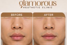 before and after image of lip reduction