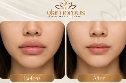 before and after images of lip reduction
