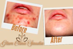 laser treatment result before and after