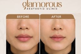 lip reduction result in riyadh